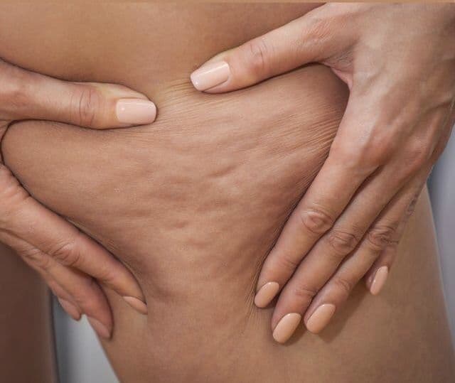 CELLULITE